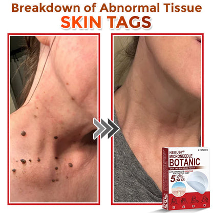 Skin Tag & Mole Removal Patches – Buy 1 Get 1 Free