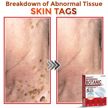 Skin Tag & Mole Removal Patches – Buy 1 Get 1 Free