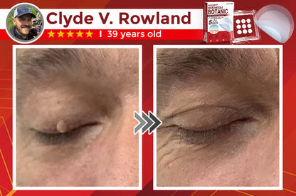 Skin Tag & Mole Removal Patches – Buy 1 Get 1 Free