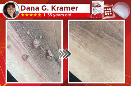 Skin Tag & Mole Removal Patches – Buy 1 Get 1 Free