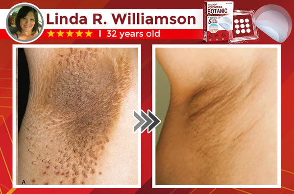 Skin Tag & Mole Removal Patches – Buy 1 Get 1 Free