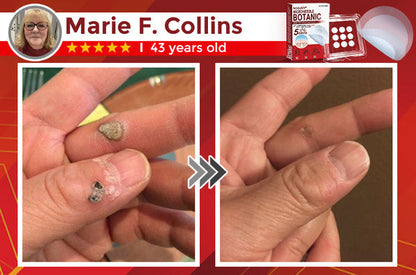 Skin Tag & Mole Removal Patches – Buy 1 Get 1 Free
