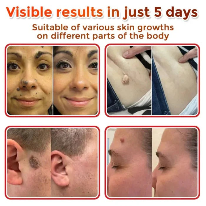 Skin Tag & Mole Removal Patches – Buy 1 Get 1 Free